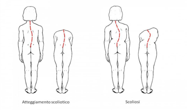 scoliosi Scoliosi e postura